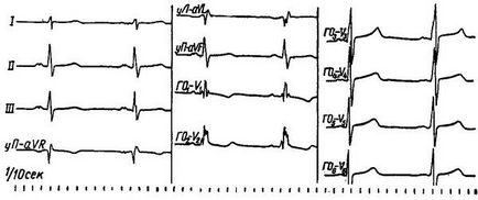 Blocul atrial, aritmii cardiace