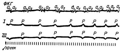 Blocul atrial, aritmii cardiace