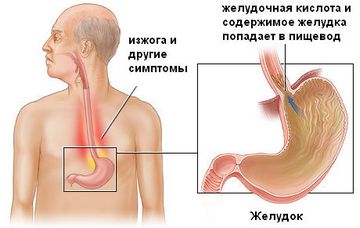 Inflamația simptomelor esofagului și a tratamentului, medicamente