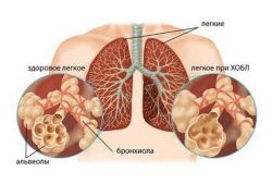 COPD - a várható élettartam