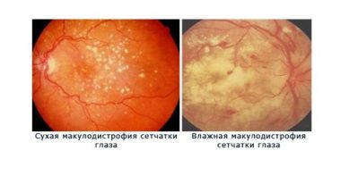 chorioretinal dystrophiában