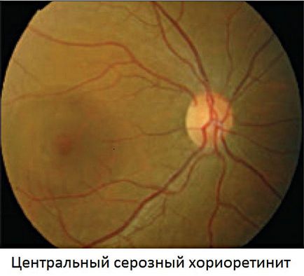 Хоріоретиніт очі лікування, симптоми і ознаки, очі і зір