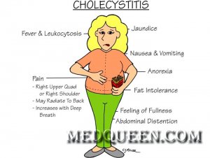 Хронічний холецистит
