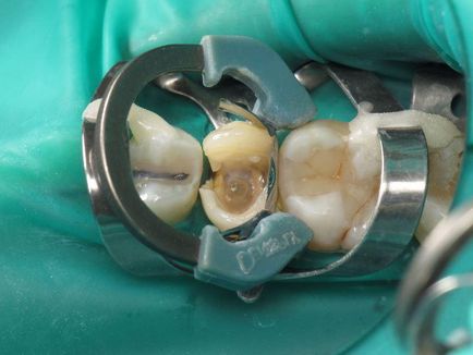 Înlocuirea restaurării - terapie - știri și articole despre stomatologie - profesională