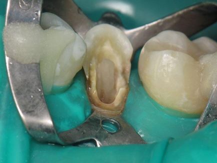 Înlocuirea restaurării - terapie - știri și articole despre stomatologie - profesională