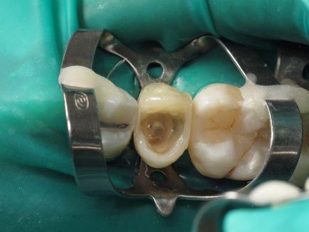 Заміна реставрації - терапія - новини і статті по стоматології - професійний