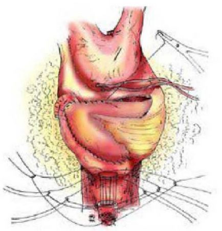 Înlocuirea vezicii cu un rezervor intestinal (chistoplastie)