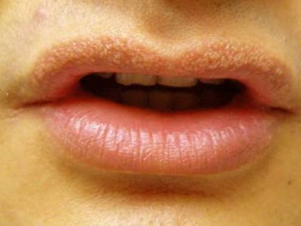 Weners pe tratamentul buzelor, cum să scapi, diagnosticul