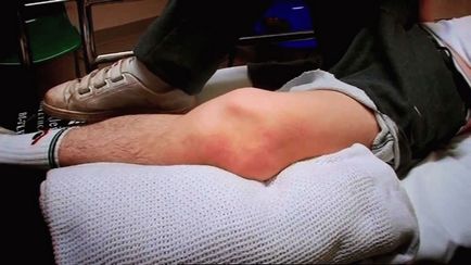Arderea în articulația genunchiului cauzează posibilă roșeață și tratament