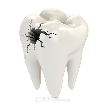 15 Mituri și fapte despre canalele dentare, stomatologia americană la Moscova - este util să știm