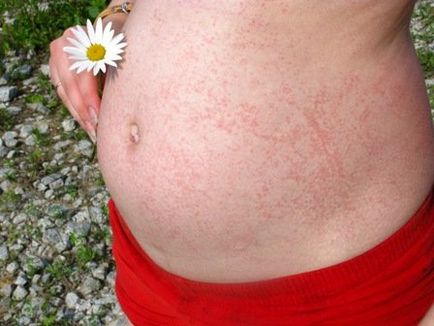 9 típusú allergia, szénanátha származó kullancsok és kidolgozás