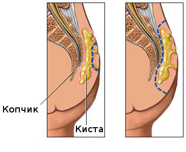 Abcesul cauzelor de coccyx, simptome și tratament