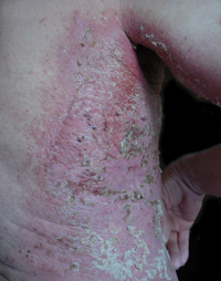 Алергічний контактний дерматит - k & amp; c діагностика і лікування захворювань в Ізраїлі, Австрії,