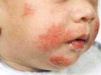Dermatita alergică de contact - k & c Diagnosticul și tratamentul bolilor în Israel, Austria,