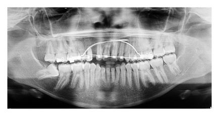 Apikoektomiya adott esetben sikertelen korrekciós vontatási hatással canine