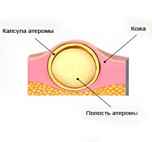 Atheroma az ágyék nőknél a szexuális ajak