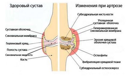 Degetul mic îi doare pe un picior sau picior, iar motivele și tratamentul cresc prost