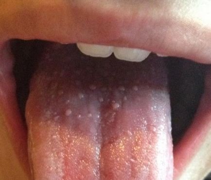 Gyulladt nyelv gyermek tünetei, okai, esetleges betegségek, a kezelés