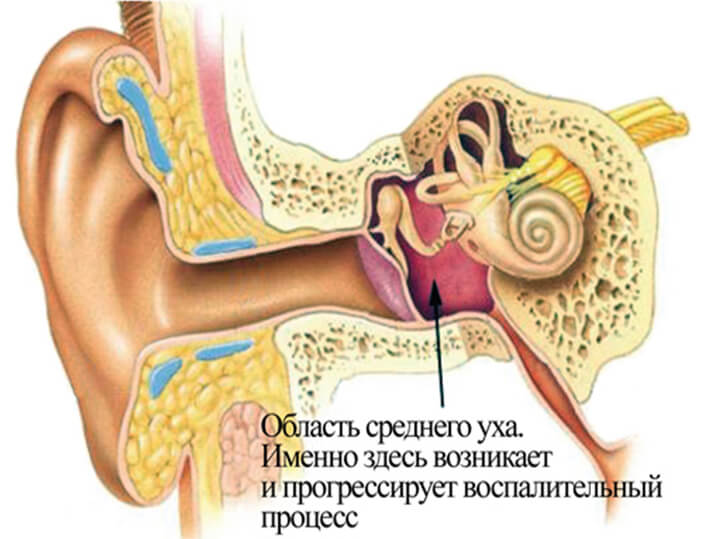 Цефтриаксон при отиті у дорослих ефективність, можливі побічні ефекти і протипоказання