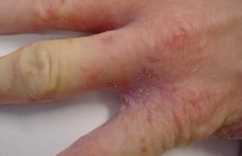 Căile de cicatrice și alergia