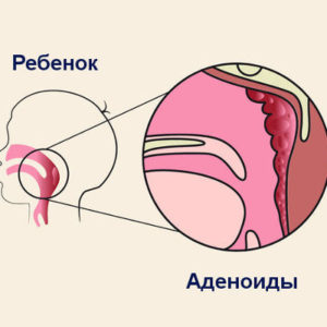 Деринат для інгаляцій небулайзером