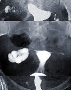 Діагностика прохідності маткових труб, гістеросальпінгографія, лапароскопія