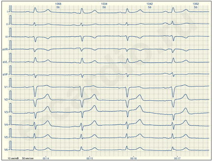 E-cardio lecție 1 (cum ar fi nu se suge)