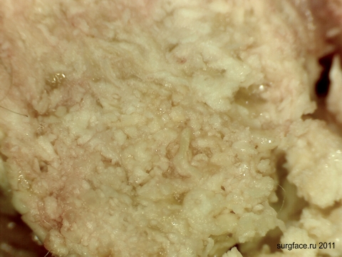 Epithelioma Malherbe (laphámrák) laphámrák Malerba