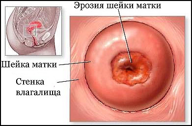 Eroziunea diagnosticului de col uterin, tratament ieftin la St. Petersburg