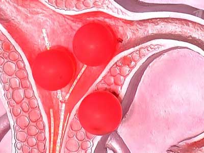 Fibromiomul simptomelor uterine și semne, tratament și tipuri