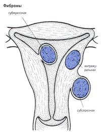 Фіброміома матки, вузлова фіброміома матки, лікування і ознаки