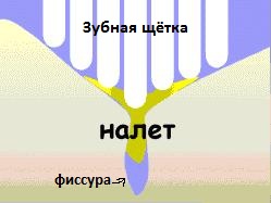 Герметизація фісур дитині, інформаційний сайт про дитячої стоматології