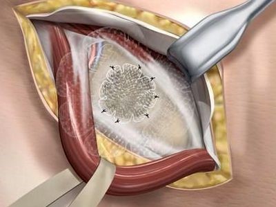 Hernioplasty „titán selyem” - megbízható eredményt sérv, International Protection Center