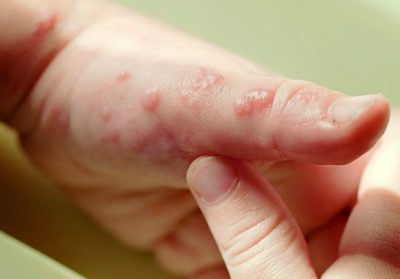 Herpesul pe mâini, degetele cauzei mâinii și tratamentul