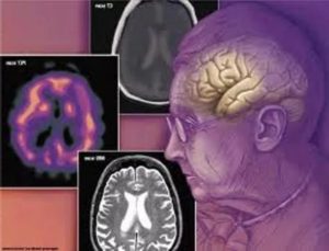 az agy egy felnőtt hydrocephalus (agy) agy hydrocephalus felnőtteknél