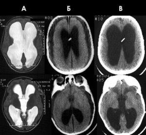 Гідроцефалія головного мозку у дорослої