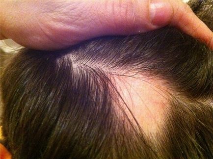 Alopecia cauzatoare de alopecie și tratamentul chelării cuiburilor