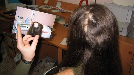 Alopecia cauzatoare de alopecie și tratamentul chelării cuiburilor
