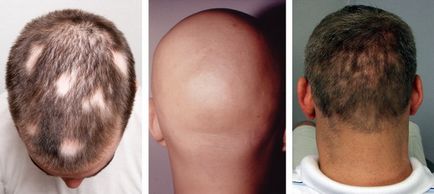 Alopecia cauzatoare de alopecie și tratamentul chelării cuiburilor