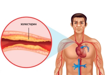 Коронарна болест на сърцето симптоми в жени, мъже и деца