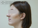 Javítás kereszt-harapás rögzítő rendszer Damon - Marina g (miatt malocclusion) Javítás kereszt-harapás rögzítő rendszer Damon - Marina g
