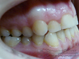 Javítás kereszt-harapás rögzítő rendszer Damon - Marina g (miatt malocclusion) Javítás kereszt-harapás rögzítő rendszer Damon - Marina g