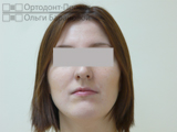 Javítás kereszt-harapás rögzítő rendszer Damon - Marina g (miatt malocclusion) Javítás kereszt-harapás rögzítő rendszer Damon - Marina g