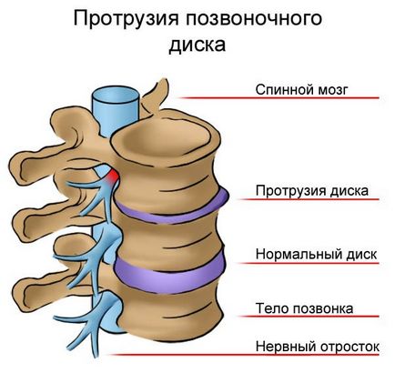 Як лікувати остеохондроз шийного відділу в домашніх умовах