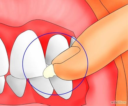 Як лікувати зламаний зуб