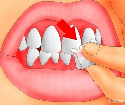 Cum se trateaza un dinte rupt