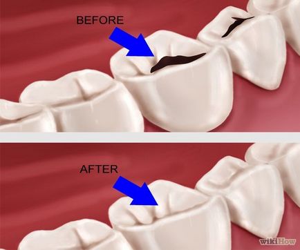 Як лікувати зламаний зуб