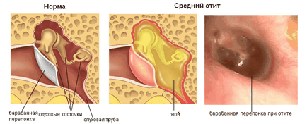 Кідрокортізон в вухо - суспензія і краплі, як їх використовувати