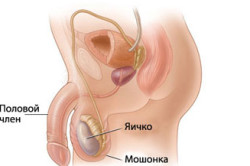 Chistul cordonului spermatic, simptomatologia, diagnosticul și tratamentul