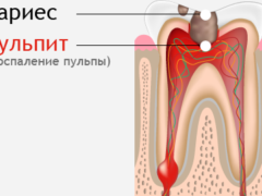 Класифікація карієсу яким він буває